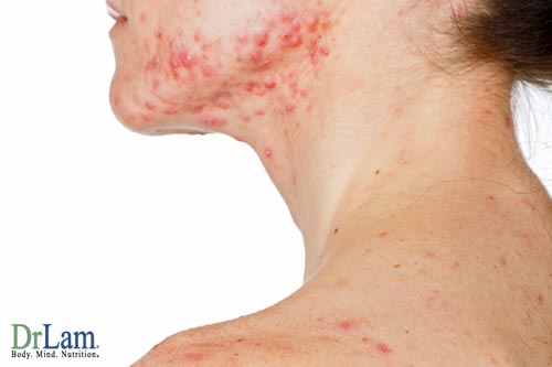 Adrenal Fatigue can affect the skin, as well