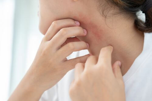 An image of a person with candida symptoms