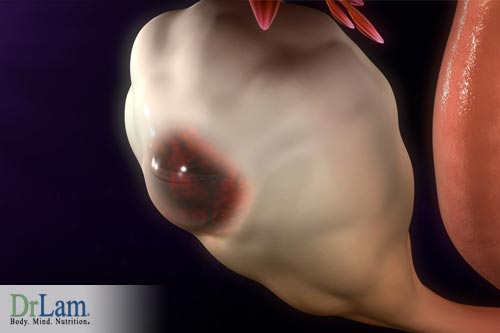 Estrogen dominance and endometriosis