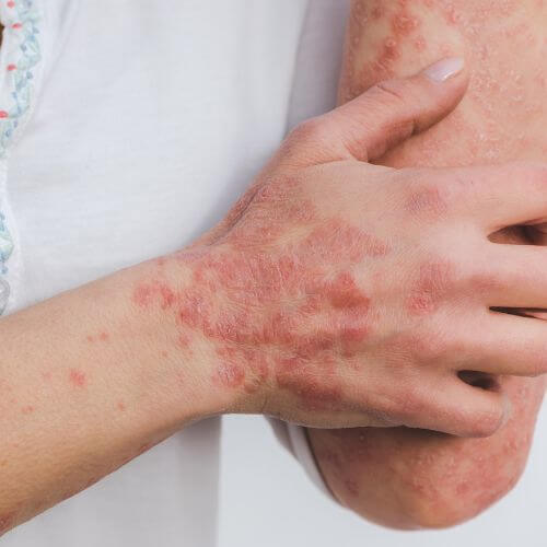 An image of a person with autoimmune disease symptoms