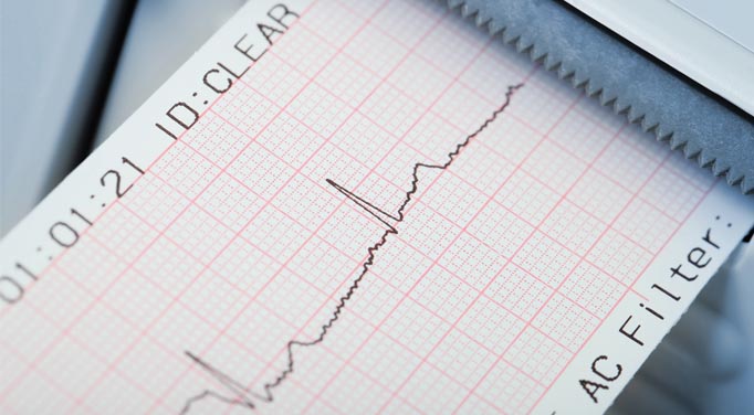 EEG readout, representing the fact that postural tachycardia syndrome affects the heart