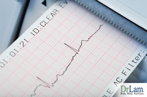 An EEG readout depicting heart rate which can be disrupted by Postural tachycardia syndrome